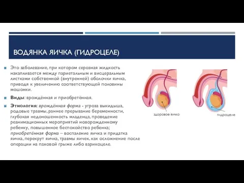 ВОДЯНКА ЯИЧКА (ГИДРОЦЕЛЕ) Это заболевание, при котором серозная жидкость накапливается