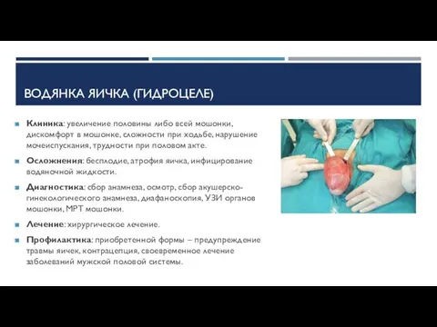 ВОДЯНКА ЯИЧКА (ГИДРОЦЕЛЕ) Клиника: увеличение половины либо всей мошонки, дискомфорт