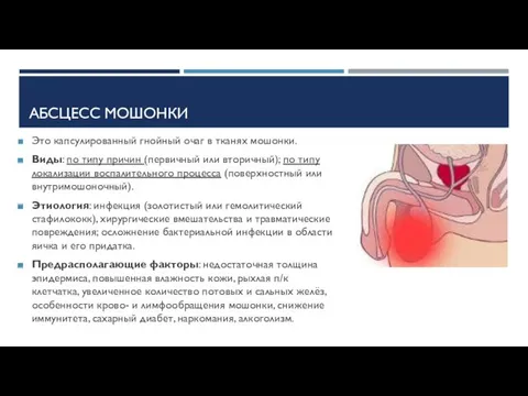 АБСЦЕСС МОШОНКИ Это капсулированный гнойный очаг в тканях мошонки. Виды: