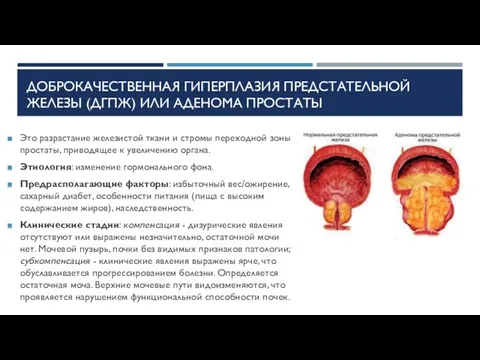 ДОБРОКАЧЕСТВЕННАЯ ГИПЕРПЛАЗИЯ ПРЕДСТАТЕЛЬНОЙ ЖЕЛЕЗЫ (ДГПЖ) ИЛИ АДЕНОМА ПРОСТАТЫ Это разрастание