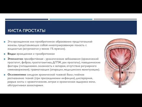 КИСТА ПРОСТАТЫ Это врожденное или приобретенное образование предстательной железы, представляющее