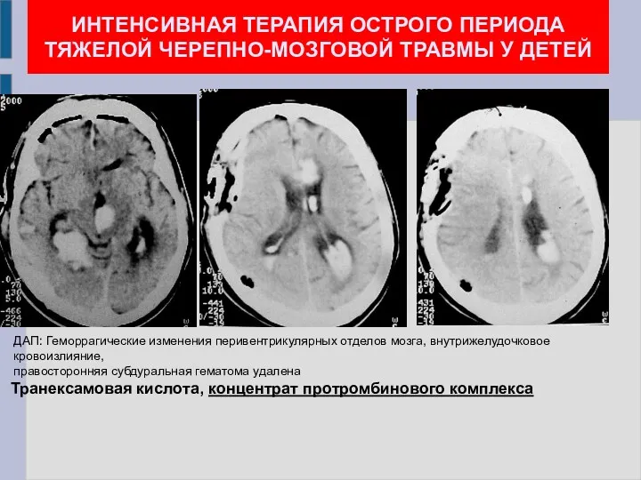 ИНТЕНСИВНАЯ ТЕРАПИЯ ОСТРОГО ПЕРИОДА ТЯЖЕЛОЙ ЧЕРЕПНО-МОЗГОВОЙ ТРАВМЫ У ДЕТЕЙ ДАП: