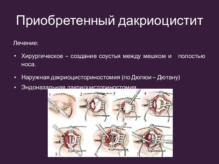 Приобретенный дакриоцистит Лечение: Хирургическое – создание соустья между мешком и