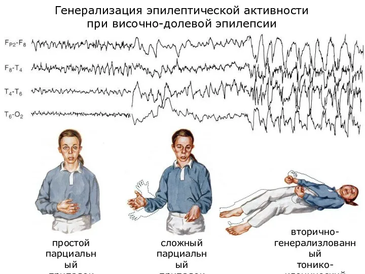 Генерализация эпилептической активности при височно-долевой эпилепсии простой парциальный припадок сложный парциальный припадок вторично- генерализлованный тонико-клонический припадок