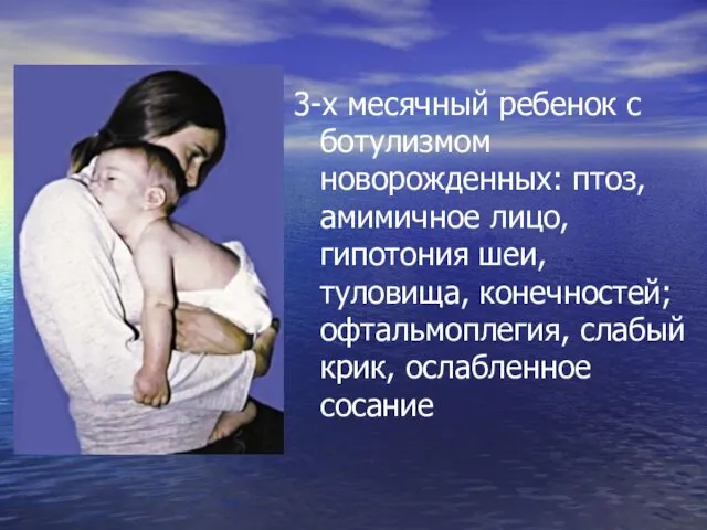 3-х месячный ребенок с ботулизмом новорожденных: птоз, амимичное лицо, гипотония