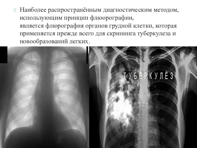 Наиболее распространённым диагностическим методом, использующим принцип флюорографии, является флюрография органов грудной клетки, которая