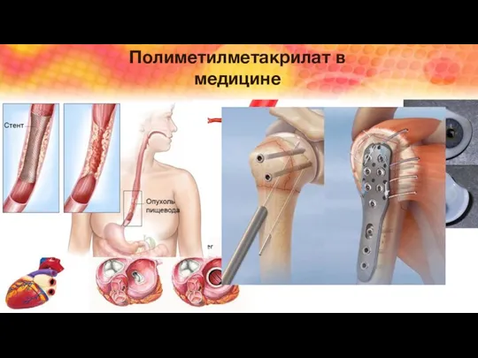 Полиметилметакрилат в медицине В настоящее время этот материал широко применяется