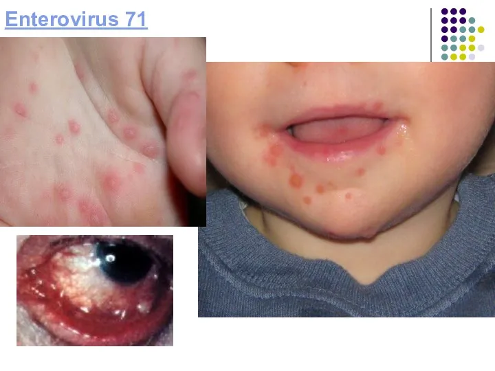 Enterovirus 71