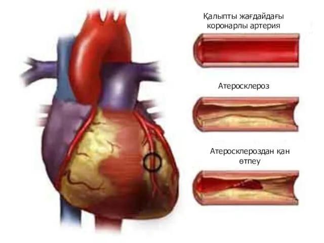 Қалыпты жағдайдағы коронарлы артерия Атеросклероз Атеросклероздан қан өтпеу