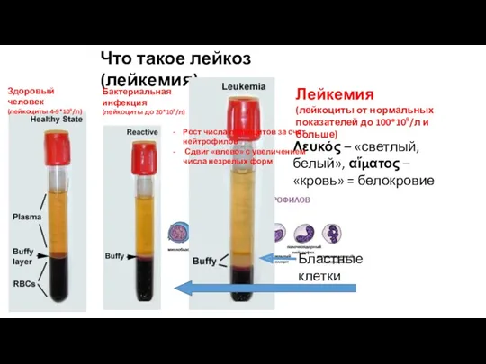 Что такое лейкоз (лейкемия) Λευκός – «светлый, белый», αἵματος –