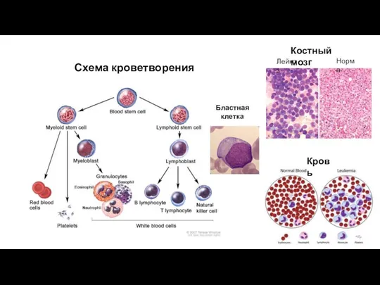 Схема кроветворения Костный мозг Лейкоз Норма Бластная клетка Кровь