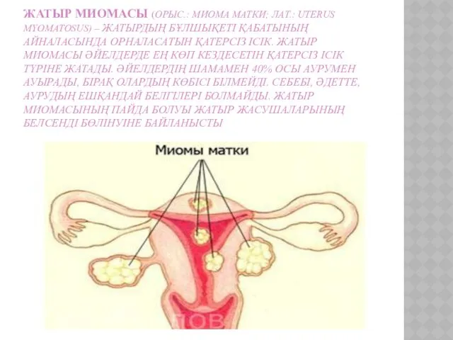 ЖАТЫР МИОМАСЫ (ОРЫС.: МИОМА МАТКИ; ЛАТ.: UTERUS MYOMATOSUS) – ЖАТЫРДЫҢ