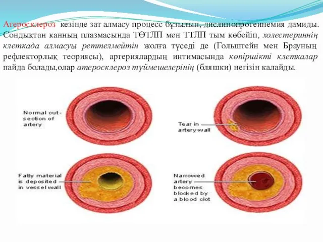 Атеросклероз кезінде зат алмасу процесс бұзылып, дислипопротеинемия дамиды. Сондықтан канның