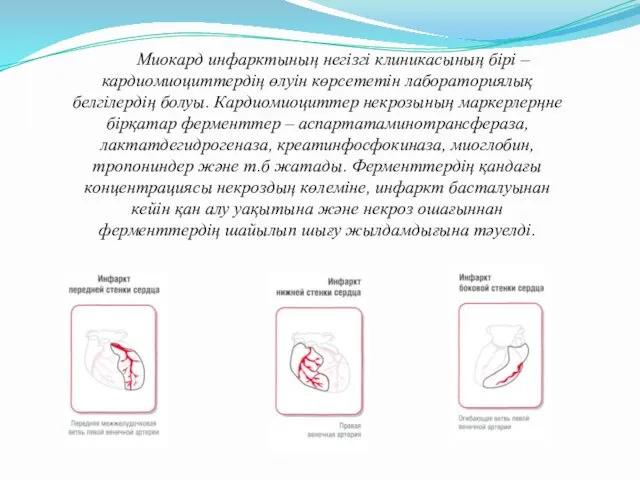 Миокард инфарктының негізгі клиникасының бірі – кардиомиоциттердің өлуін көрсететін лабораториялық