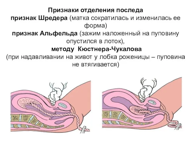 Признаки отделения последа признак Шредера (матка сократилась и изменилась ее