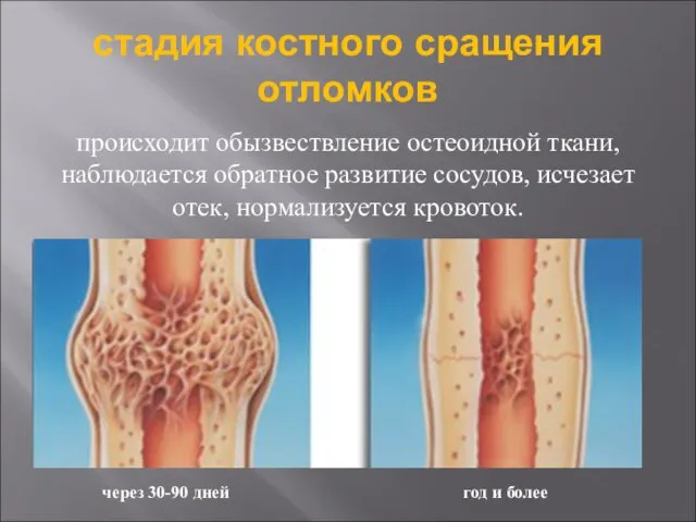 стадия костного сращения отломков происходит обызвествление остеоидной ткани, наблюдается обратное