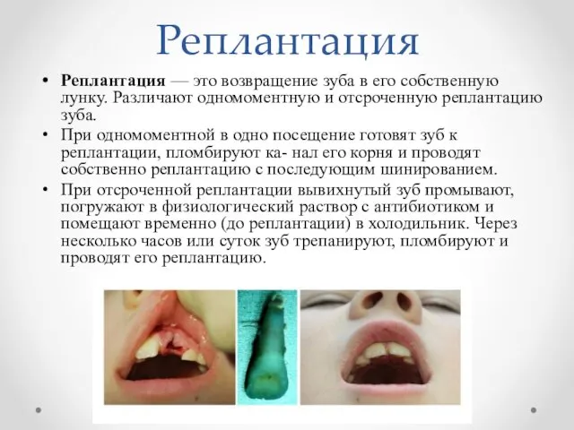 Реплантация Реплантация — это возвращение зуба в его собственную лунку. Различают одномоментную и
