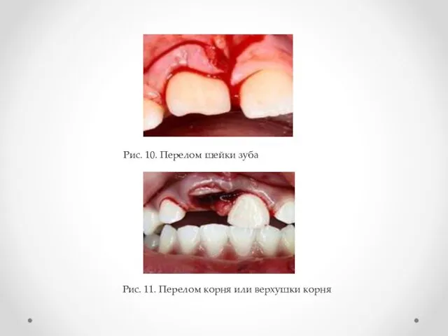 Рис. 10. Перелом шейки зуба Рис. 11. Перелом корня или верхушки корня