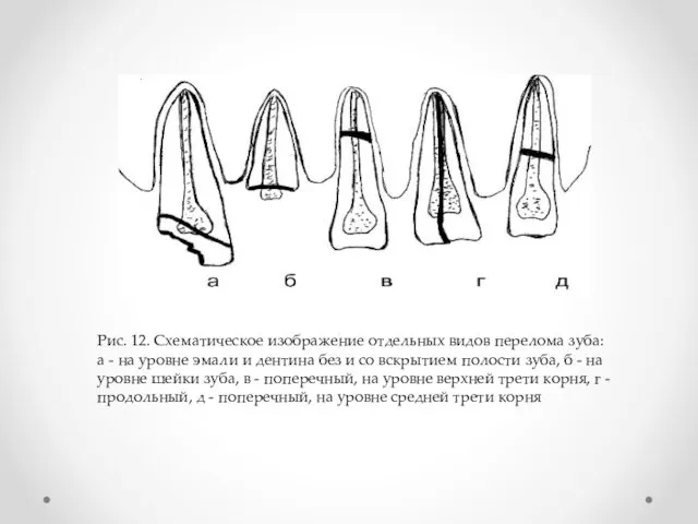Рис. 12. Схематическое изображение отдельных видов перелома зуба: а - на уровне эмали