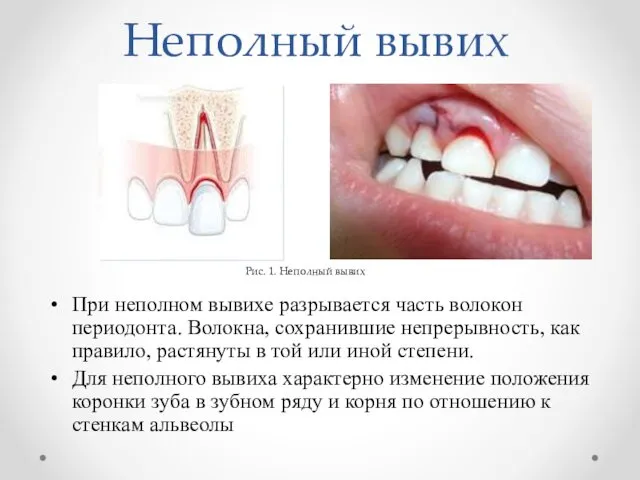 Неполный вывих При неполном вывихе разрывается часть волокон периодонта. Волокна, сохранившие непрерывность, как