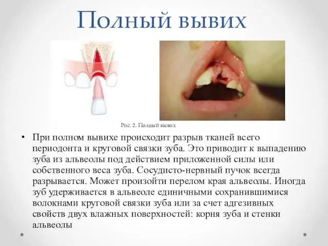 Полный вывих При полном вывихе происходит разрыв тканей всего периодонта и круговой связки