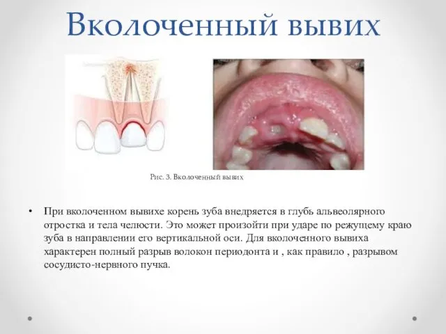 Вколоченный вывих При вколоченном вывихе корень зуба внедряется в глубь альвеолярного отростка и
