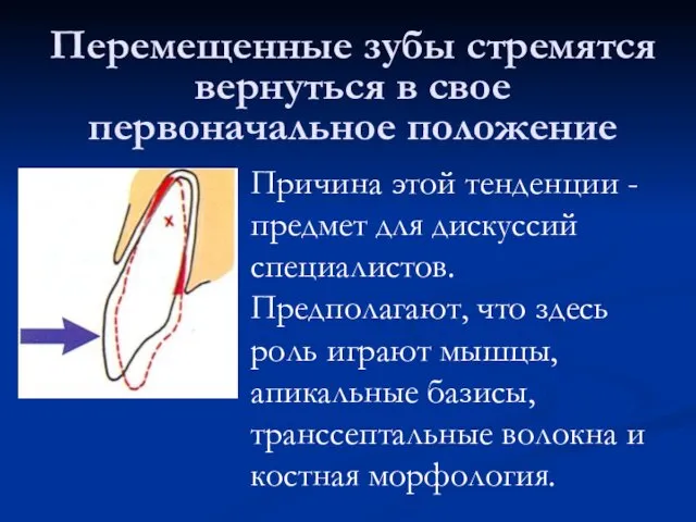 Перемещенные зубы стремятся вернуться в свое первоначальное положение Причина этой