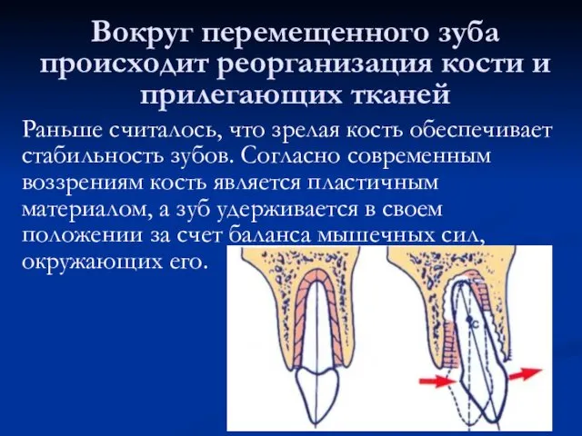 Вокруг перемещенного зуба происходит реорганизация кости и прилегающих тканей Раньше