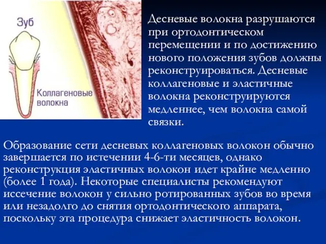 Десневые волокна разрушаются при ортодонтическом перемещении и по достижению нового