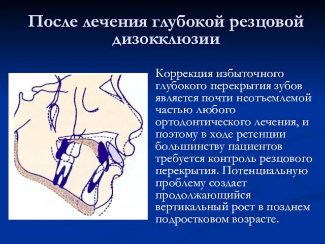 После лечения глубокой резцовой дизокклюзии Коррекция избыточного глубокого перекрытия зубов