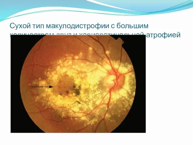 Сухой тип макулодистрофии с большим количеством друз и хориоретинальной атрофией