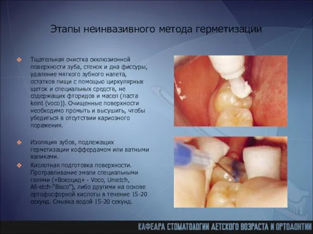 Этапы неинвазивного метода герметизации Тщательная очистка окклюзионной поверхности зуба, стенок