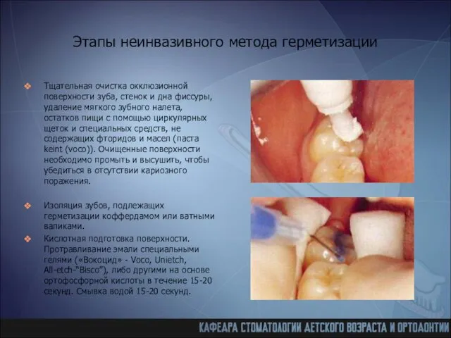 Этапы неинвазивного метода герметизации Тщательная очистка окклюзионной поверхности зуба, стенок и дна фиссуры,