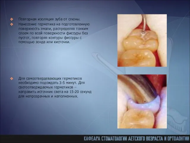 Повторная изоляция зуба от слюны. Нанесение герметика на подготовленную поверхность эмали, распределяя тонким