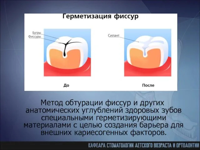 Метод обтурации фиссур и других анатомических углублений здоровых зубов специальными