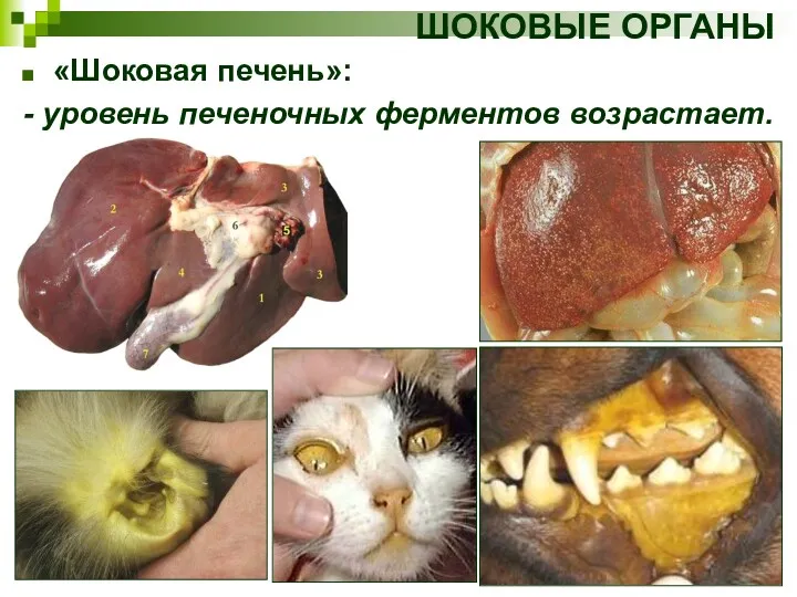 ШОКОВЫЕ ОРГАНЫ «Шоковая печень»: - уровень печеночных ферментов возрастает.