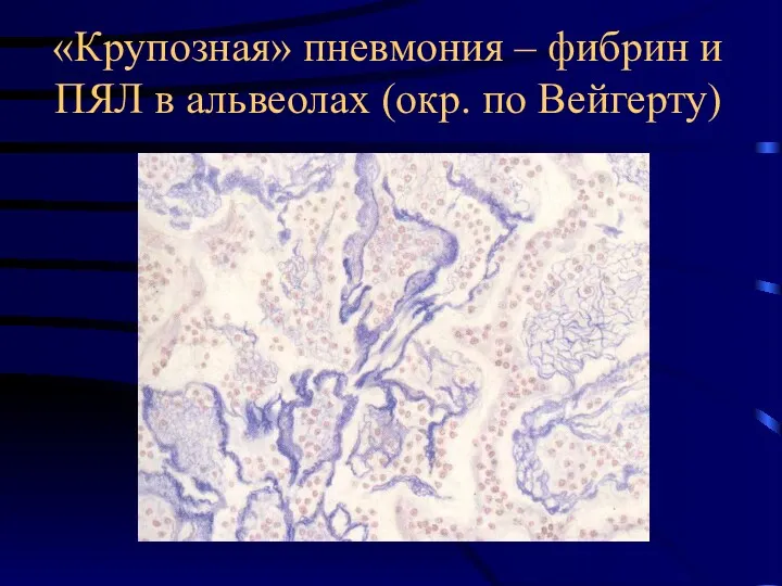 «Крупозная» пневмония – фибрин и ПЯЛ в альвеолах (окр. по Вейгерту)