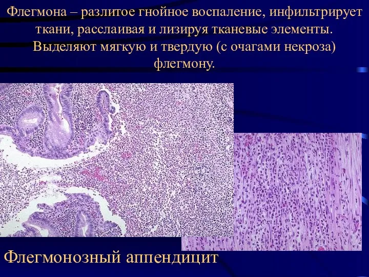 Флегмона – разлитое гнойное воспаление, инфильтрирует ткани, расслаивая и лизируя тканевые элементы. Выделяют