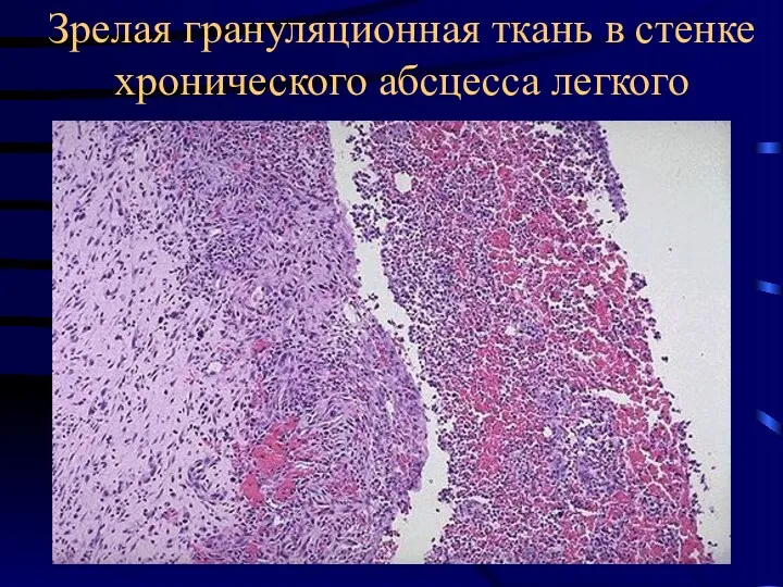 Зрелая грануляционная ткань в стенке хронического абсцесса легкого