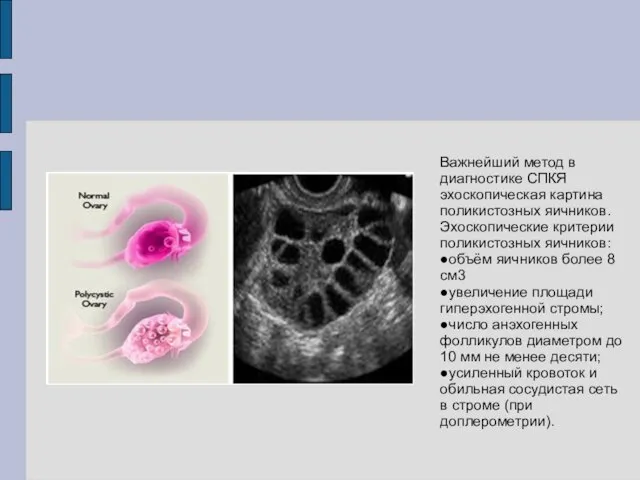 Важнейший метод в диагностике СПКЯ эхоскопическая картина поликистозных яичников. Эхоскопические