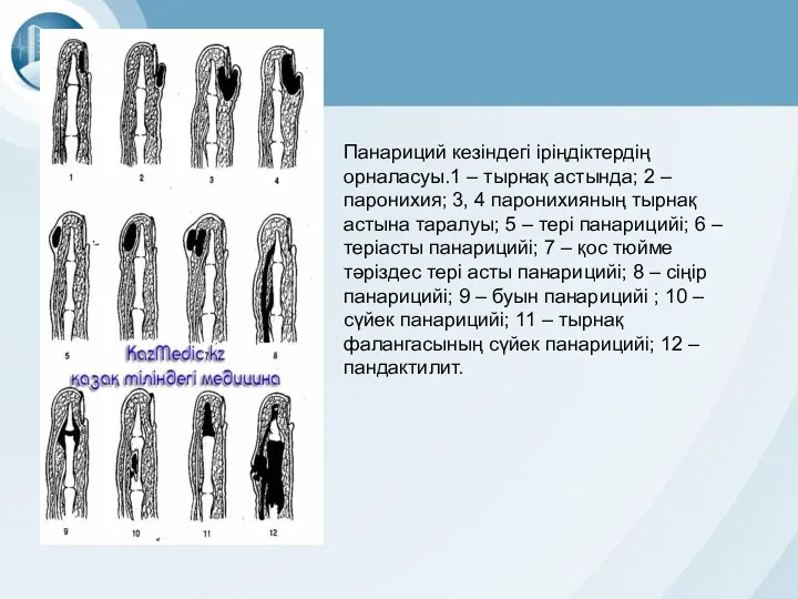 Панариций кезіндегі іріңдіктердің орналасуы.1 – тырнақ астында; 2 – паронихия;