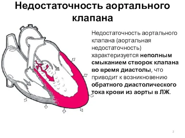 Недостаточность аортального клапана Недостаточность аортального клапана (аортальная недостаточность) характеризуется неполным