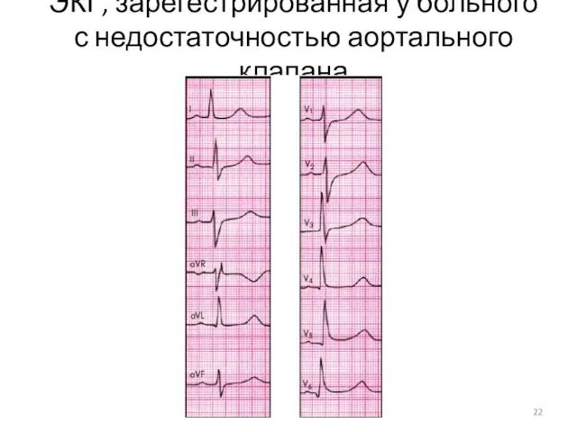 ЭКГ, зарегестрированная у больного с недостаточностью аортального клапана