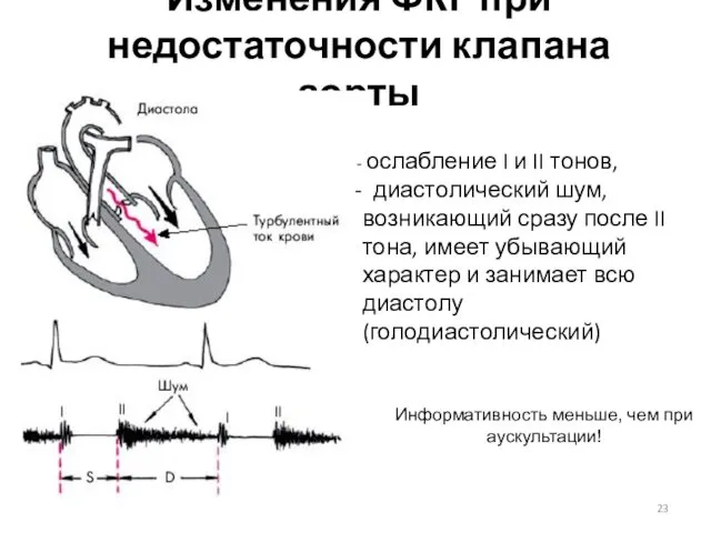 Изменения ФКГ при недостаточности клапана аорты ослабление I и II тонов, диастолический шум,