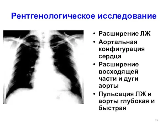 Рентгенологическое исследование Расширение ЛЖ Аортальная конфигурация сердца Расширение восходящей части и дуги аорты