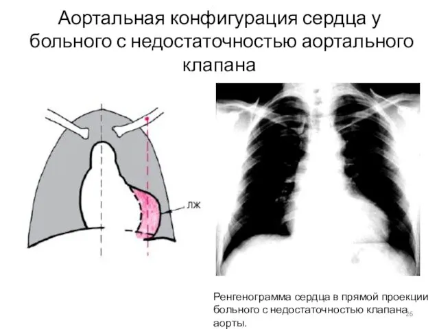 Аортальная конфигурация сердца у больного с недостаточностью аортального клапана Ренгенограмма сердца в прямой