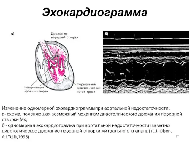 Эхокардиограмма Изменение одномерной эхокардиограммыпри аортальной недостаточности: а- схема, поясняющая возможный