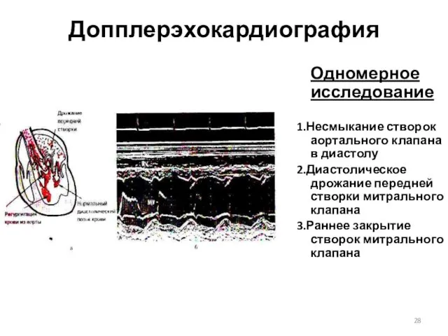 Допплерэхокардиография Одномерное исследование 1.Несмыкание створок аортального клапана в диастолу 2.Диастолическое дрожание передней створки