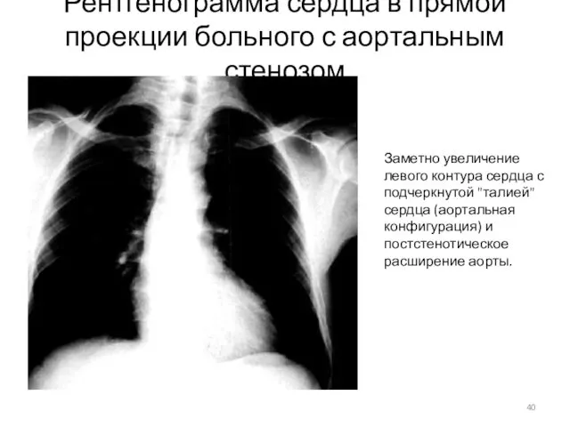 Рентгенограмма сердца в прямой проекции больного с аортальным стенозом Заметно