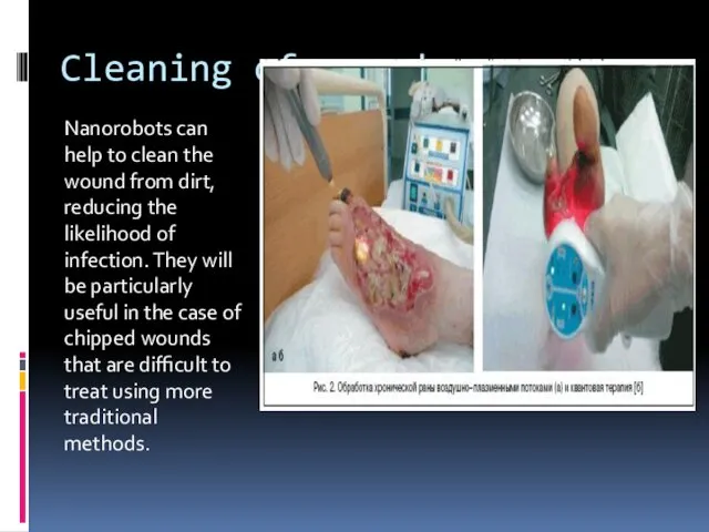 Cleaning of wounds Nanorobots can help to clean the wound